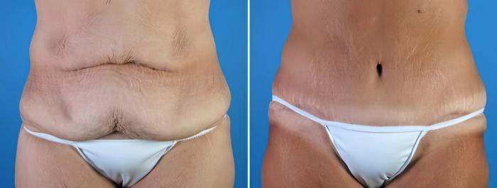 Before & After Tummy Tuck Case 18120 View #2 View in Alpharetta, GA