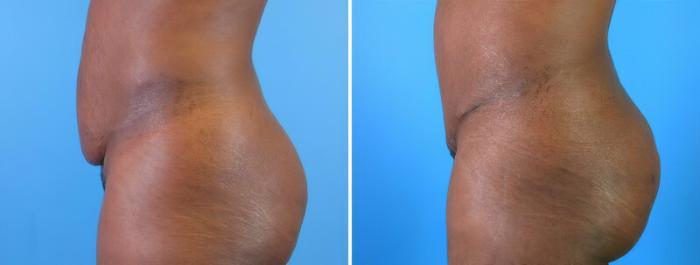 Before & After Tummy Tuck Case 18123 View #1 View in Alpharetta, GA