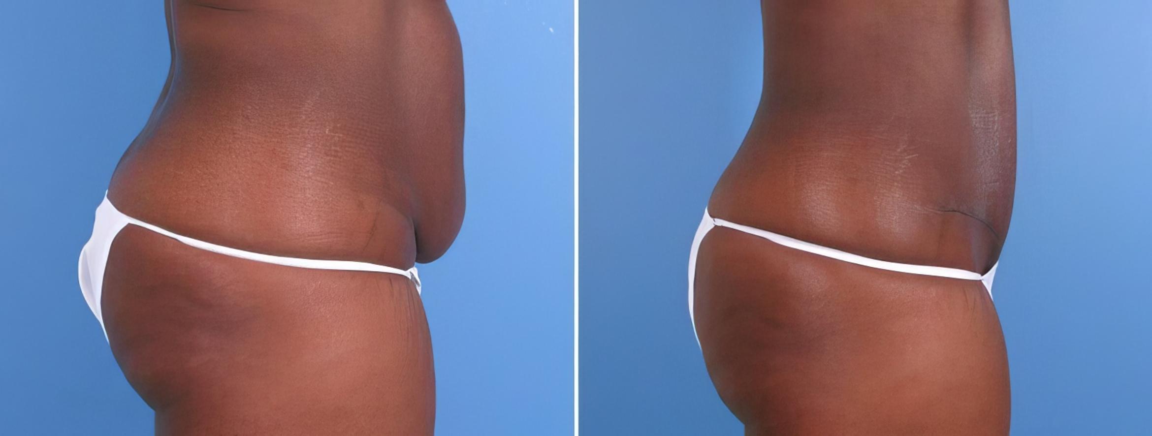 Before & After Tummy Tuck Case 18126 View #1 View in Alpharetta, GA