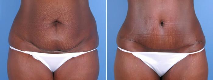 Before & After Tummy Tuck Case 18126 View #2 View in Alpharetta, GA
