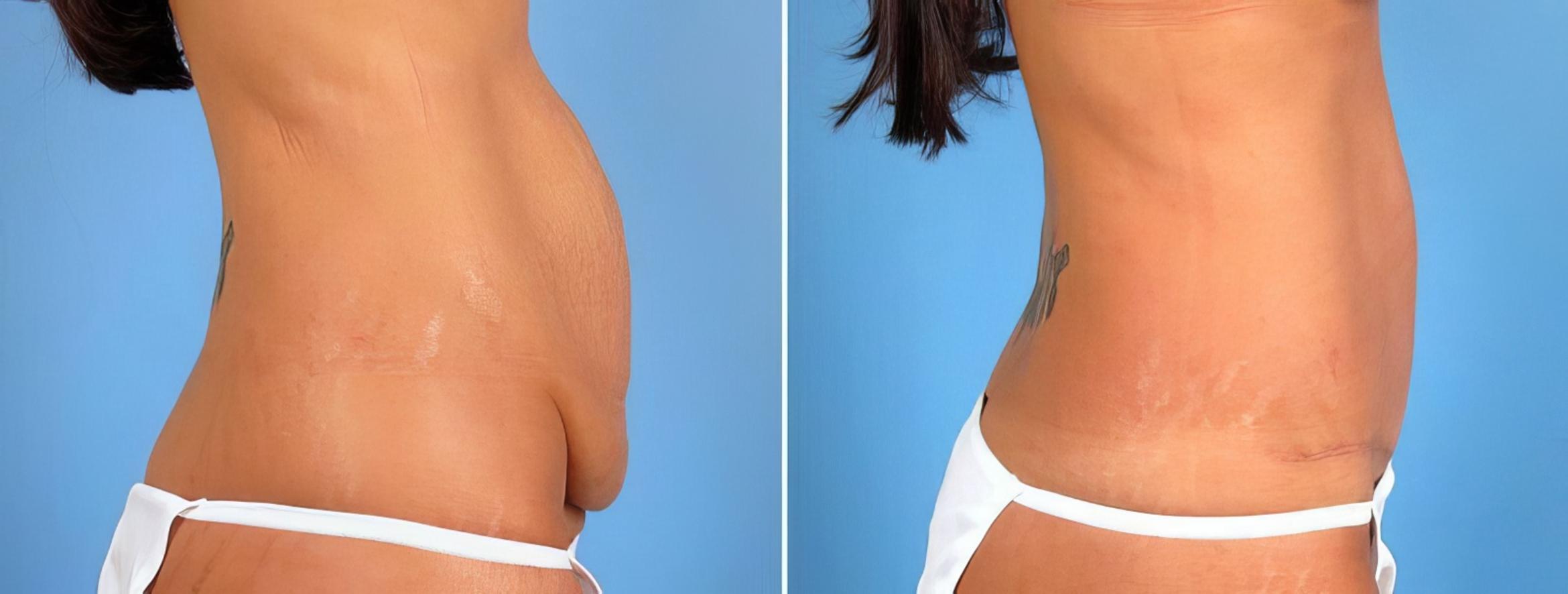 Before & After Tummy Tuck Case 18129 View #1 View in Alpharetta, GA