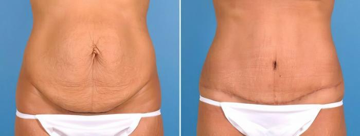 Before & After Tummy Tuck Case 18129 View #2 View in Alpharetta, GA