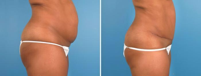 Before & After Tummy Tuck Case 18138 View #1 View in Alpharetta, GA