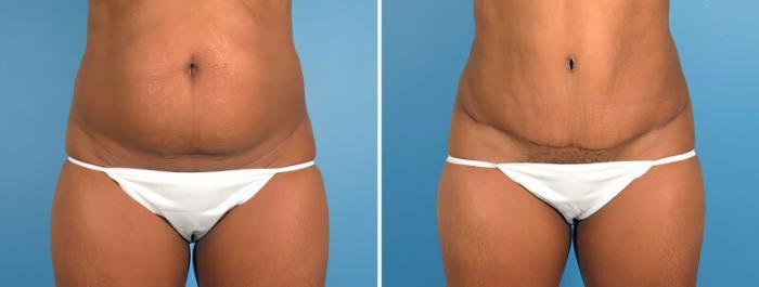 Before & After Tummy Tuck Case 18138 View #2 View in Alpharetta, GA