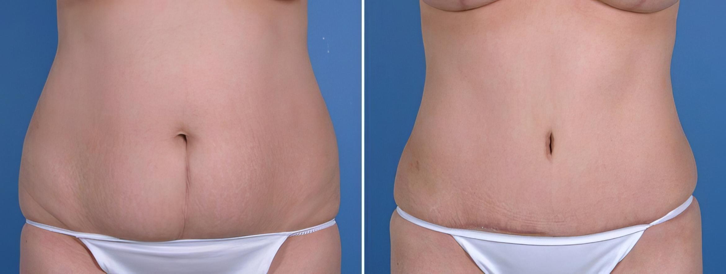 Before & After Tummy Tuck Case 18783 View #1 View in Alpharetta, GA