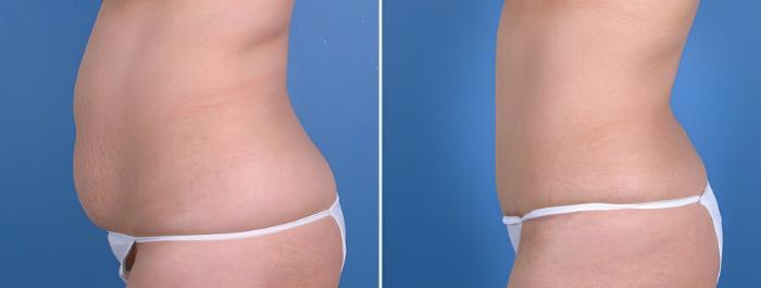 Before & After Tummy Tuck Case 18783 View #2 View in Alpharetta, GA