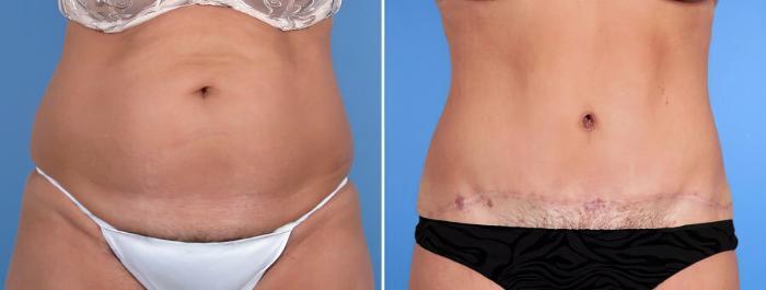 Before & After Tummy Tuck Case 18786 View #1 View in Alpharetta, GA