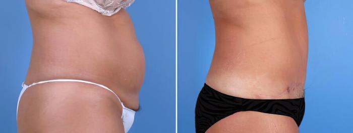 Before & After Tummy Tuck Case 18786 View #2 View in Alpharetta, GA