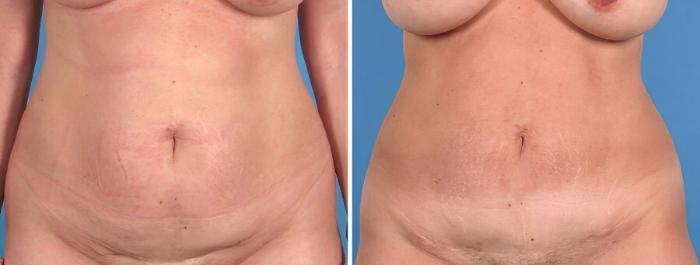 Before & After Tummy Tuck Case 18787 View #1 View in Alpharetta, GA