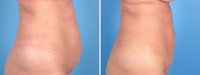 Before & After Tummy Tuck Case 18787 View #2 View in Alpharetta, GA