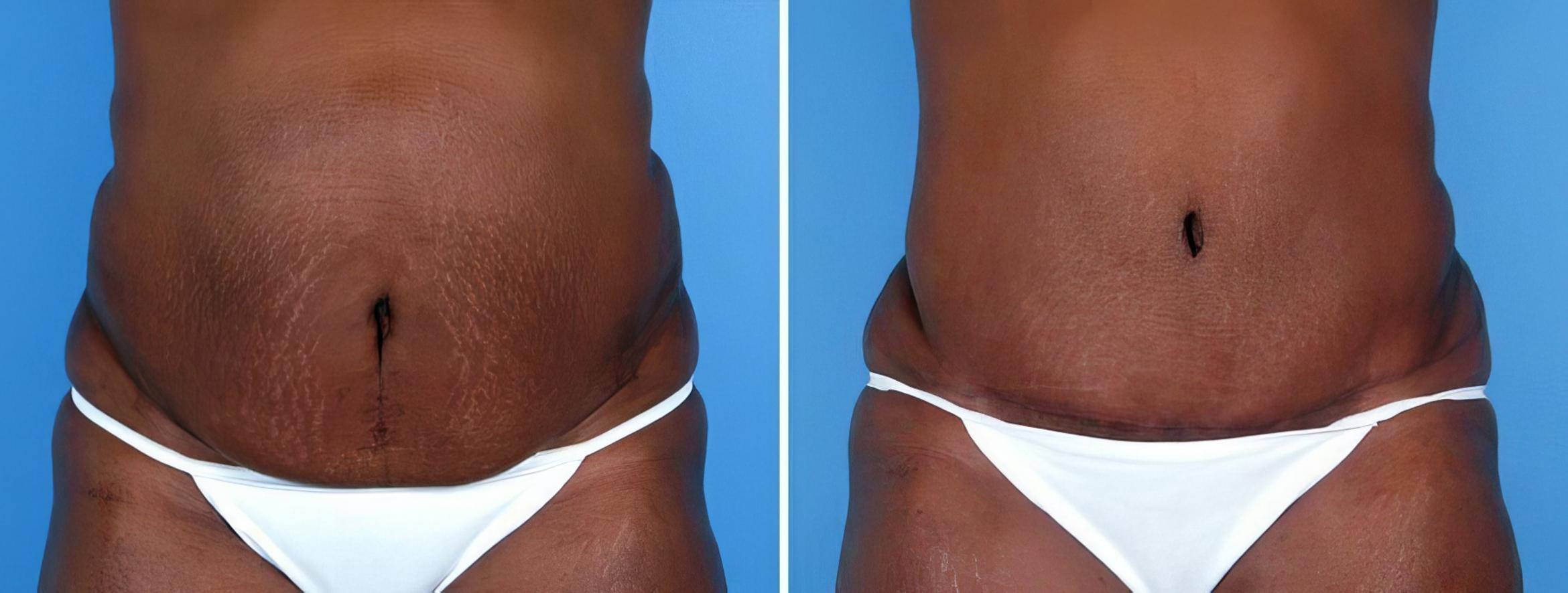 Before & After Tummy Tuck Case 19272 View #1 View in Alpharetta, GA