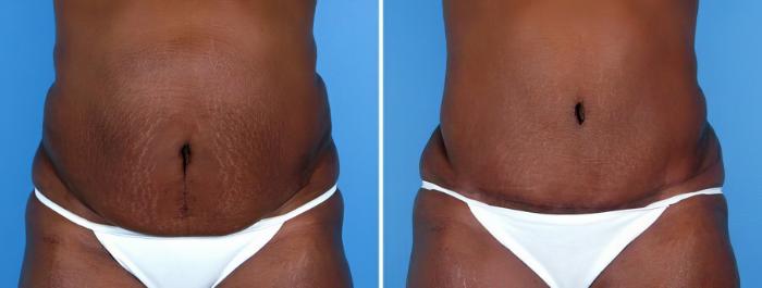 Before & After Tummy Tuck Case 19272 View #1 View in Alpharetta, GA