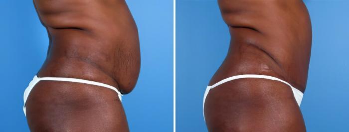 Before & After Tummy Tuck Case 19272 View #2 View in Alpharetta, GA