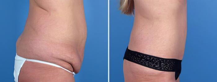 Before & After Tummy Tuck Case 25008 View #2 View in Alpharetta, GA