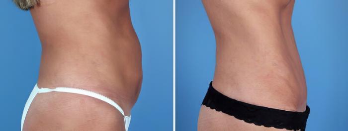 Before & After Tummy Tuck Case 25011 View #2 View in Alpharetta, GA