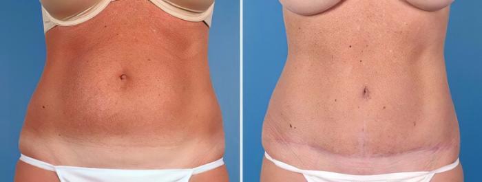 Before & After Tummy Tuck Case 25014 View #1 View in Alpharetta, GA