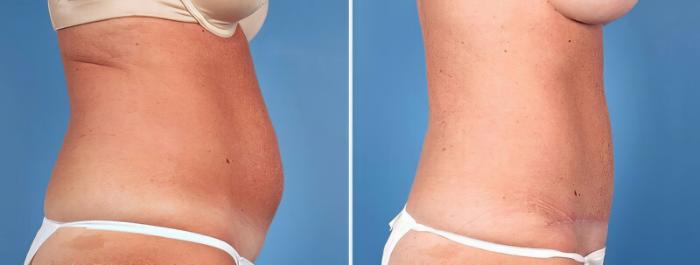 Before & After Tummy Tuck Case 25014 View #2 View in Alpharetta, GA