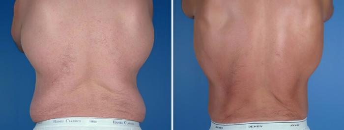 Before & After Tummy Tuck Case 25017 View #2 View in Alpharetta, GA