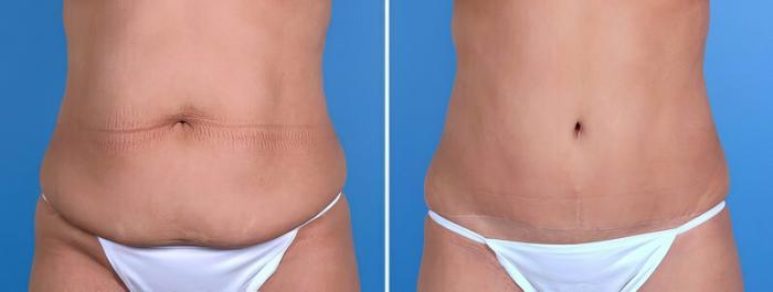 Before & After Tummy Tuck Case 25023 View #1 View in Alpharetta, GA