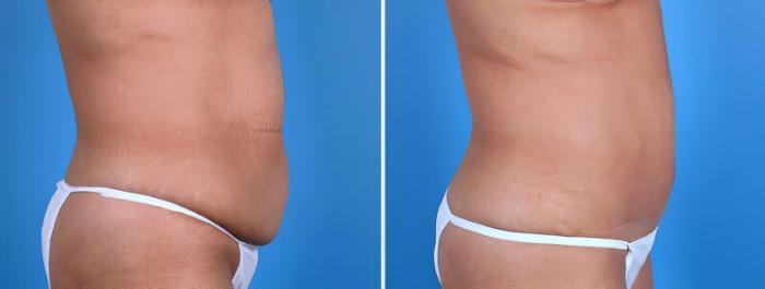 Before & After Tummy Tuck Case 25023 View #2 View in Alpharetta, GA