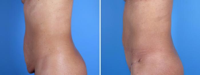 Before & After Tummy Tuck Case 25026 View #2 View in Alpharetta, GA