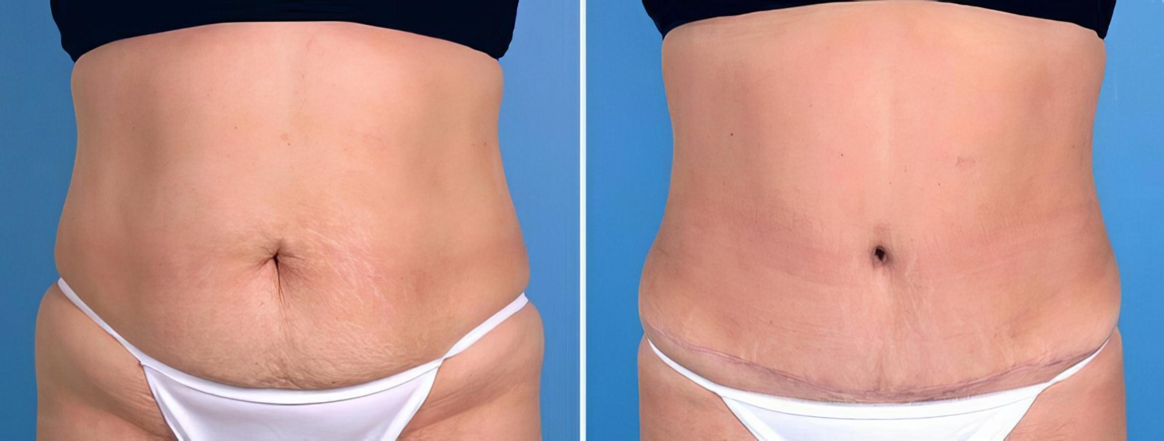 Before & After Tummy Tuck Case 25507 View #1 View in Alpharetta, GA