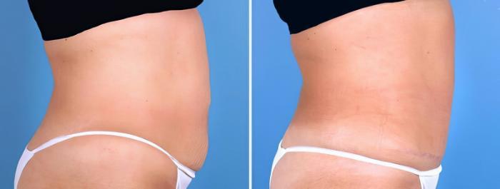 Before & After Tummy Tuck Case 25507 View #2 View in Alpharetta, GA