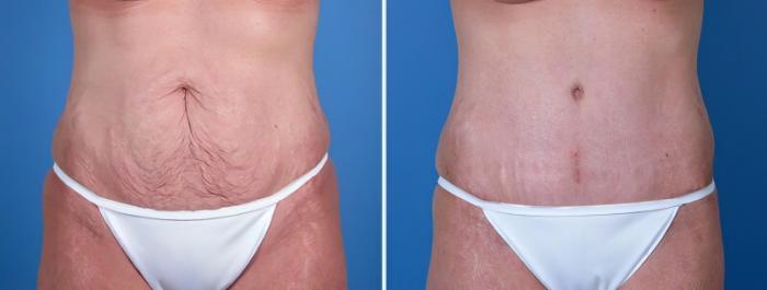 Before & After Tummy Tuck Case 25583 View #1 View in Alpharetta, GA