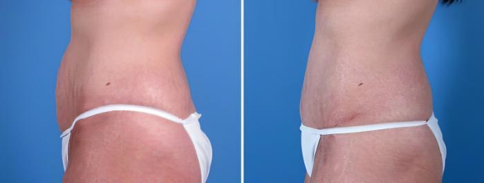 Before & After Tummy Tuck Case 25583 View #2 View in Alpharetta, GA