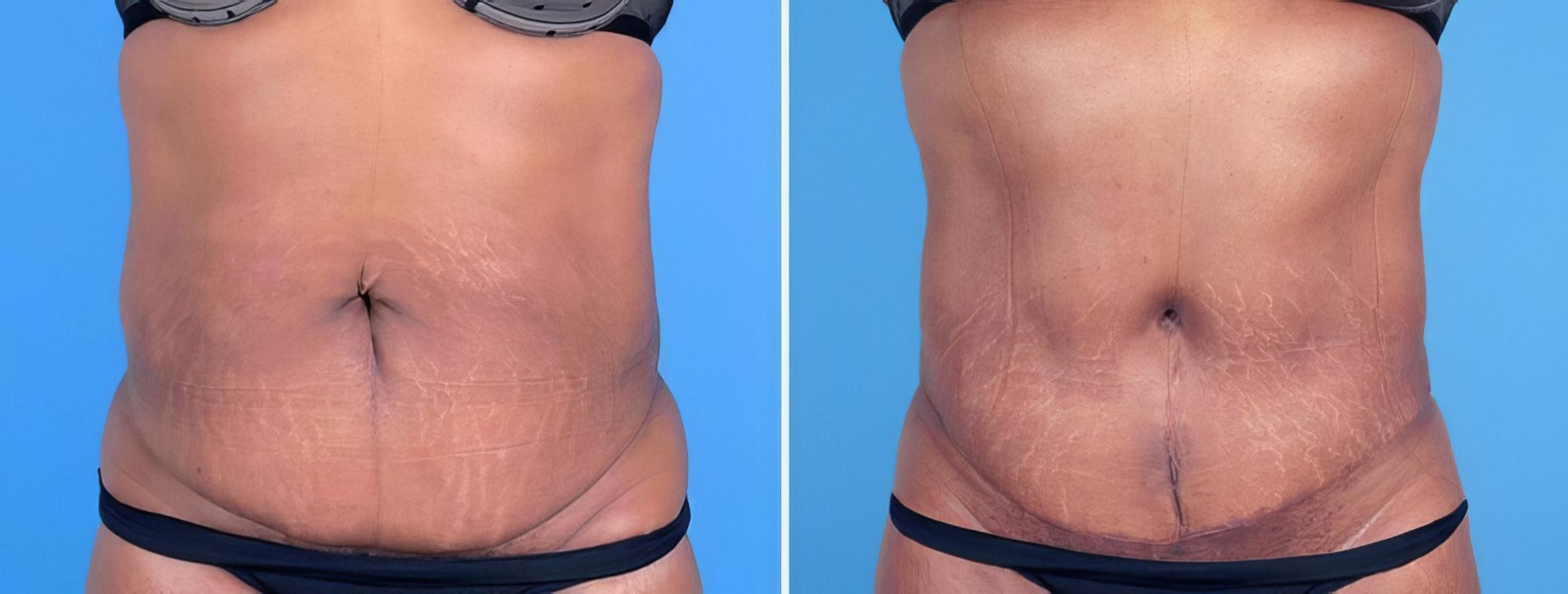 Before & After Tummy Tuck Case 25662 View #1 View in Alpharetta, GA
