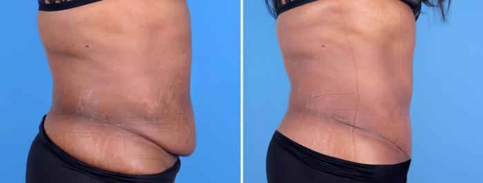 Before & After Tummy Tuck Case 25662 View #2 View in Alpharetta, GA