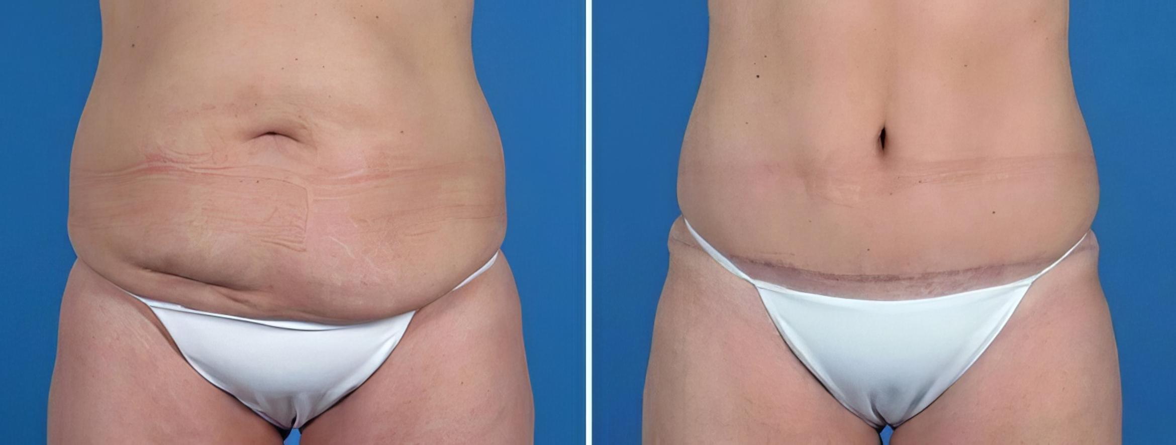 Before & After Tummy Tuck Case 25804 View #1 View in Alpharetta, GA