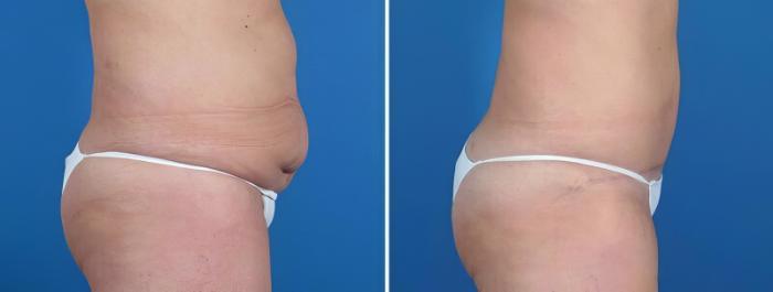 Before & After Tummy Tuck Case 25804 View #2 View in Alpharetta, GA