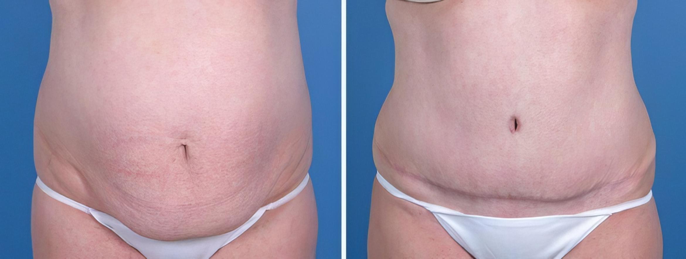 Before & After Tummy Tuck Case 25807 View #1 View in Alpharetta, GA