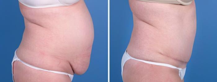 Before & After Tummy Tuck Case 25807 View #2 View in Alpharetta, GA