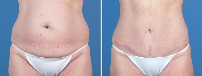 Before & After Tummy Tuck Case 26028 View #1 View in Alpharetta, GA