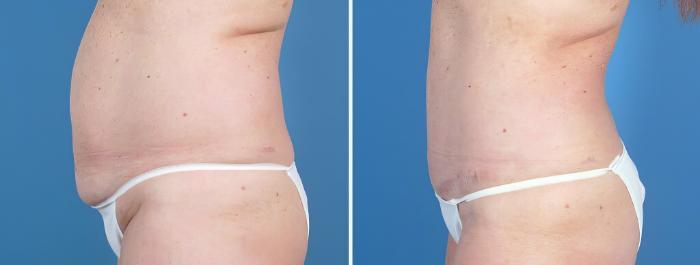 Before & After Tummy Tuck Case 26028 View #2 View in Alpharetta, GA