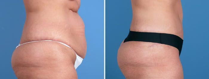 Before & After Tummy Tuck Case 26215 View #2 View in Alpharetta, GA