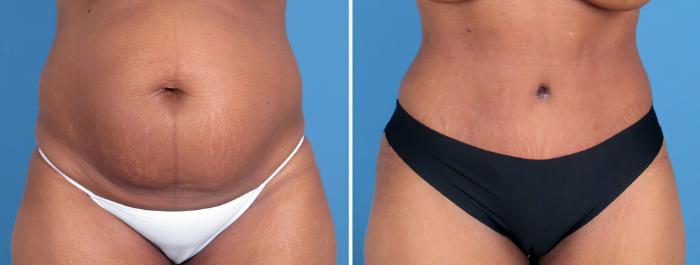 Before & After Tummy Tuck Case 26218 View #1 View in Alpharetta, GA