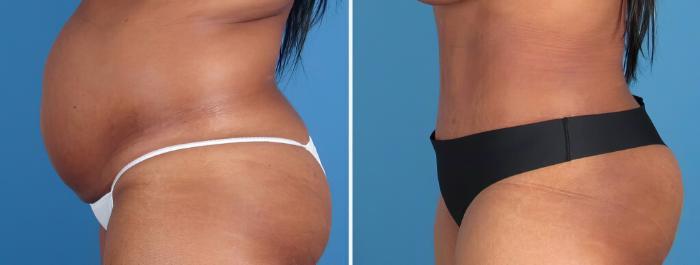 Before & After Tummy Tuck Case 26218 View #2 View in Alpharetta, GA