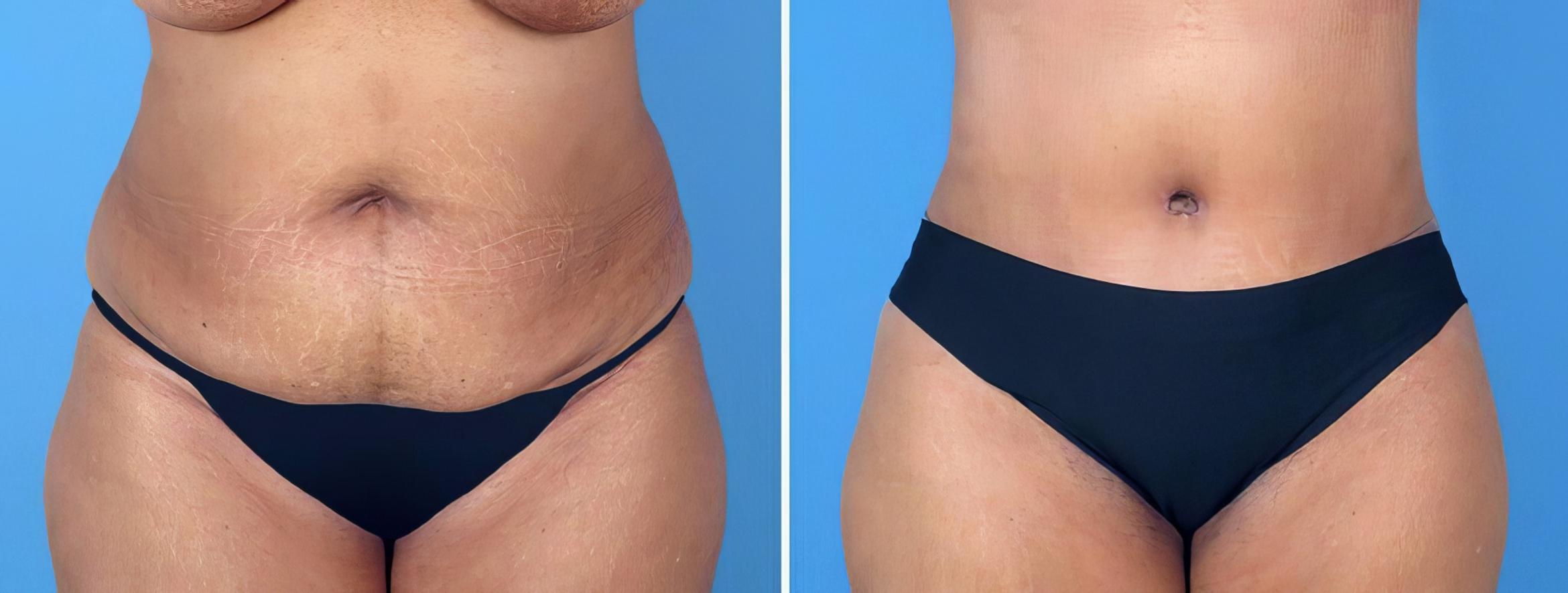 Before & After Tummy Tuck Case 26493 View #1 View in Alpharetta, GA
