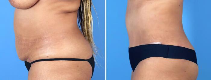 Before & After Tummy Tuck Case 26493 View #2 View in Alpharetta, GA
