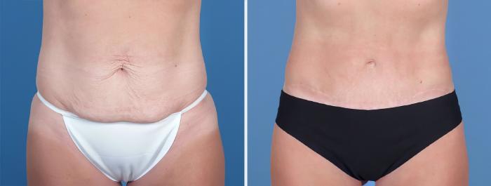Before & After Tummy Tuck Case 26794 View #1 View in Alpharetta, GA