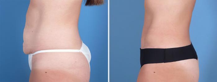 Before & After Tummy Tuck Case 26794 View #2 View in Alpharetta, GA