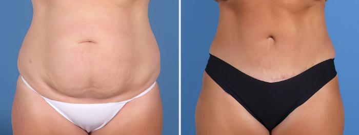 Before & After Tummy Tuck Case 26847 View #1 View in Alpharetta, GA