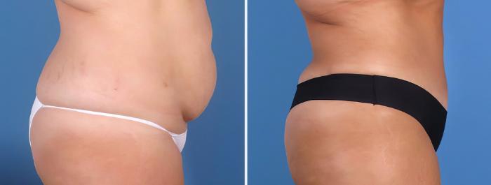 Before & After Tummy Tuck Case 26847 View #2 View in Alpharetta, GA