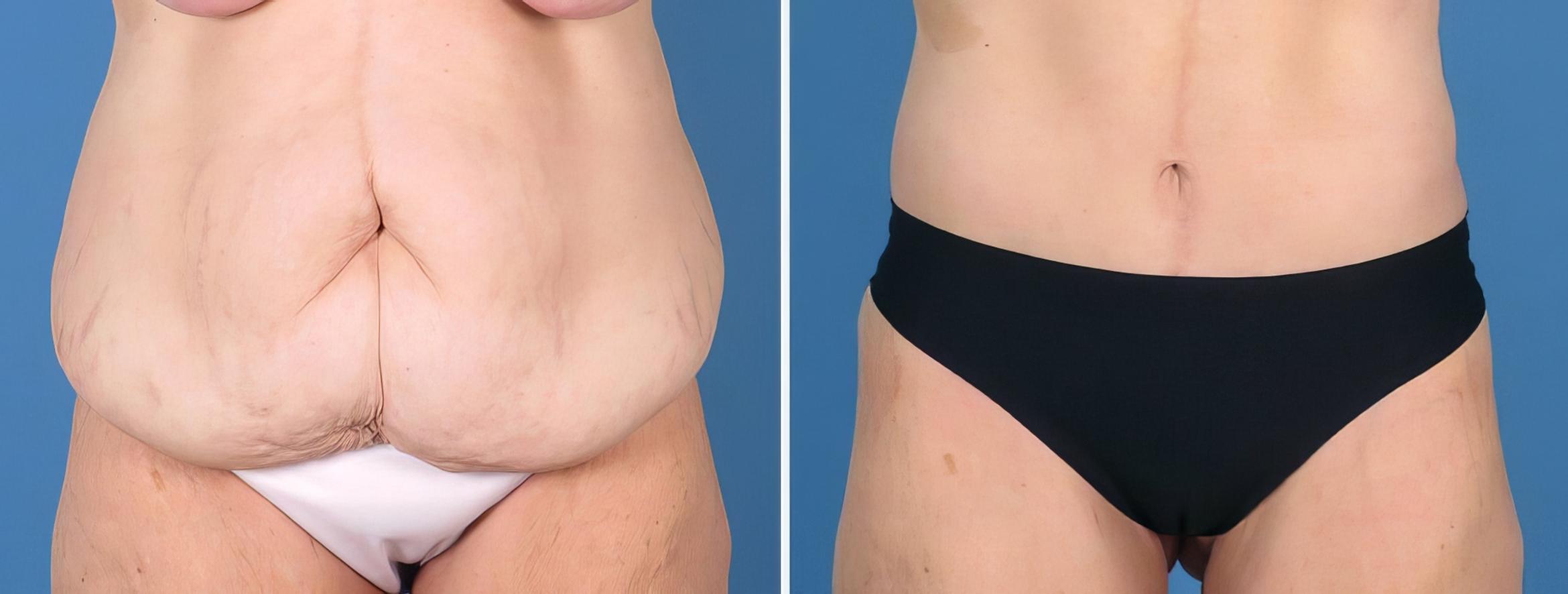 Before & After Tummy Tuck Case 27016 View #1 View in Alpharetta, GA