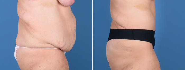 Before & After Tummy Tuck Case 27016 View #2 View in Alpharetta, GA