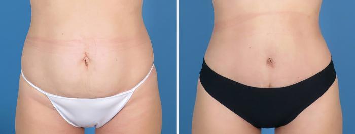 Before & After Tummy Tuck Case 27019 View #1 View in Alpharetta, GA