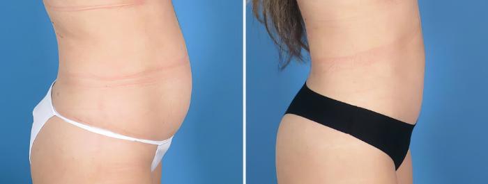 Before & After Tummy Tuck Case 27019 View #2 View in Alpharetta, GA